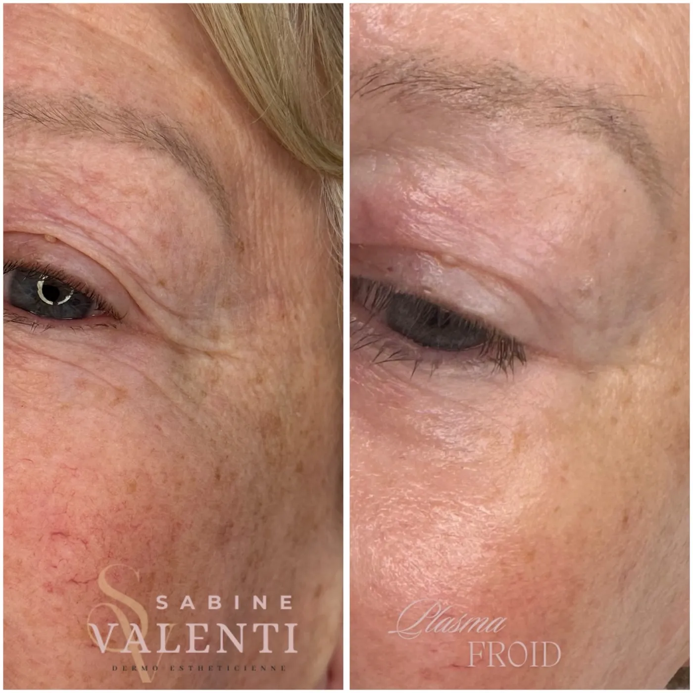 Plasma Froid, contour de l'œil, avant et après