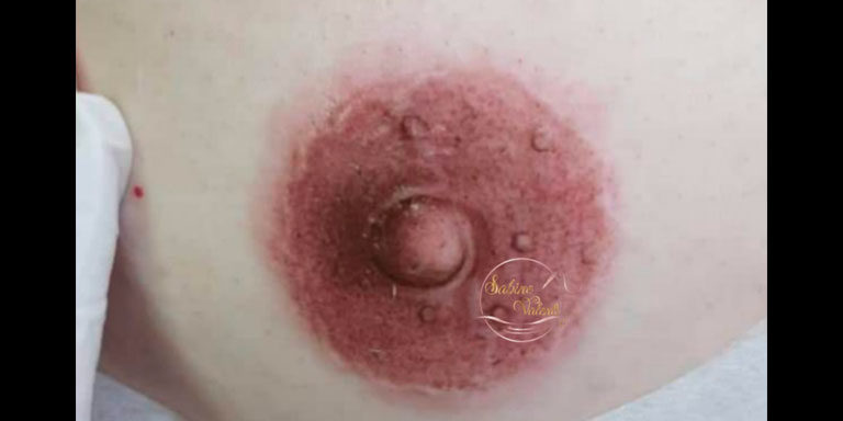 Tatouage Aréole Mamaire en dermopigmentataion paramédicale sabine valenti